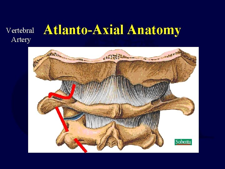 Vertebral Artery Atlanto-Axial Anatomy 