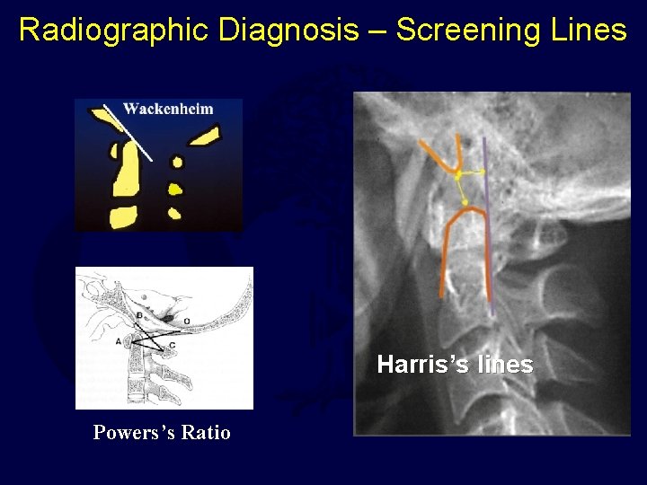 Radiographic Diagnosis – Screening Lines Harris’s lines Powers’s Ratio 