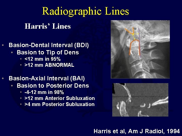 Radiographic Lines Harris’ Lines • Basion-Dental Interval (BDI) • Basion to Tip of Dens