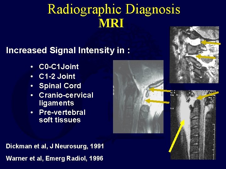 Radiographic Diagnosis MRI Increased Signal Intensity in : • • C 0 -C 1