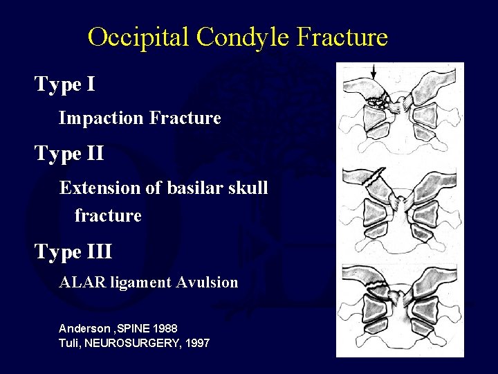 Occipital Condyle Fracture Type I Impaction Fracture Type II Extension of basilar skull fracture