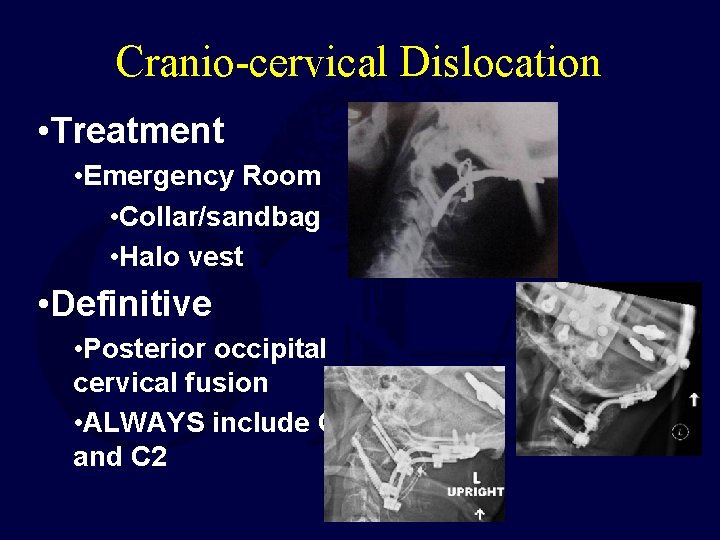 Cranio-cervical Dislocation • Treatment • Emergency Room • Collar/sandbag • Halo vest • Definitive