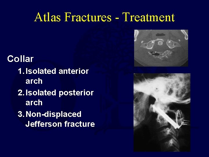 Atlas Fractures - Treatment Collar 1. Isolated anterior arch 2. Isolated posterior arch 3.