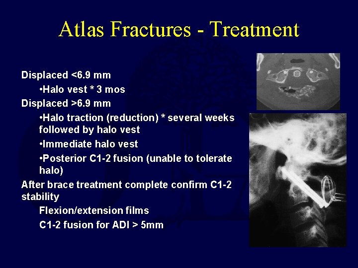 Atlas Fractures - Treatment Displaced <6. 9 mm • Halo vest * 3 mos