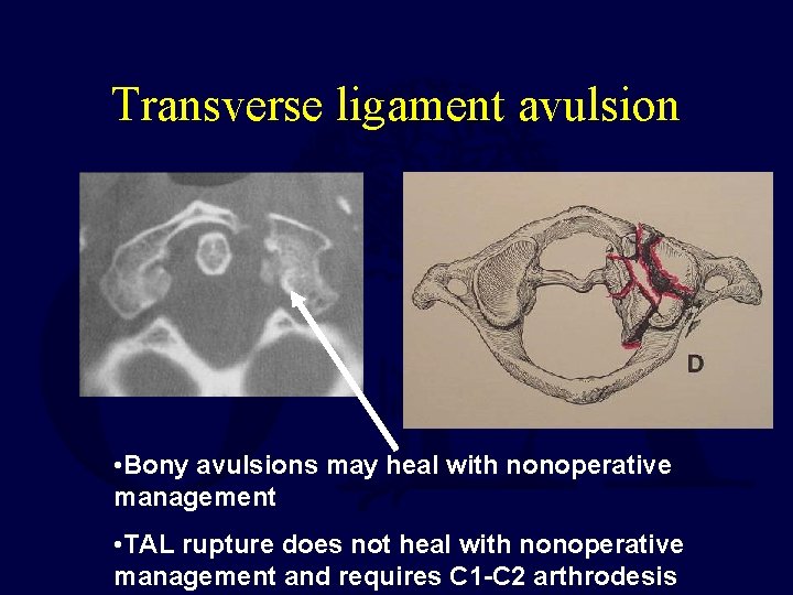 Transverse ligament avulsion • Bony avulsions may heal with nonoperative management • TAL rupture