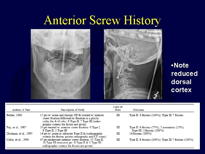 Anterior Screw History • Note reduced dorsal cortex 