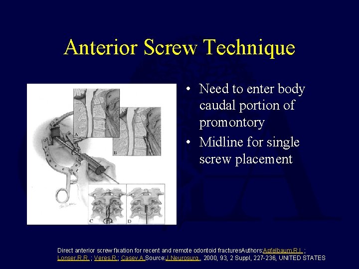 Anterior Screw Technique • Need to enter body caudal portion of promontory • Midline