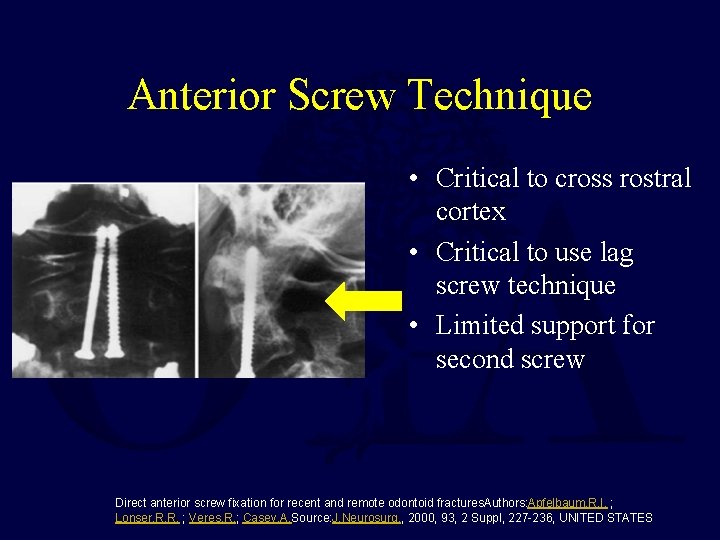 Anterior Screw Technique • Critical to cross rostral cortex • Critical to use lag