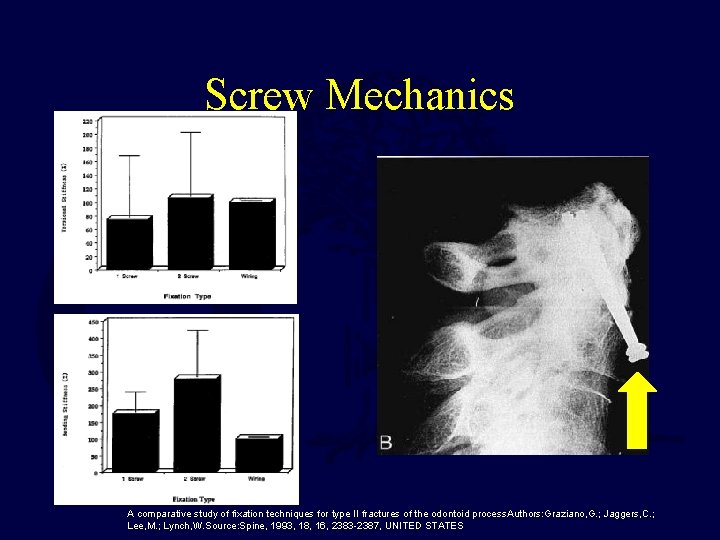 Screw Mechanics A comparative study of fixation techniques for type II fractures of the