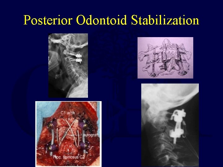 Posterior Odontoid Stabilization 