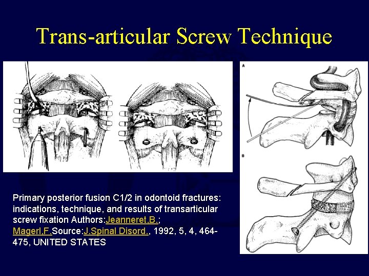 Trans-articular Screw Technique Primary posterior fusion C 1/2 in odontoid fractures: indications, technique, and