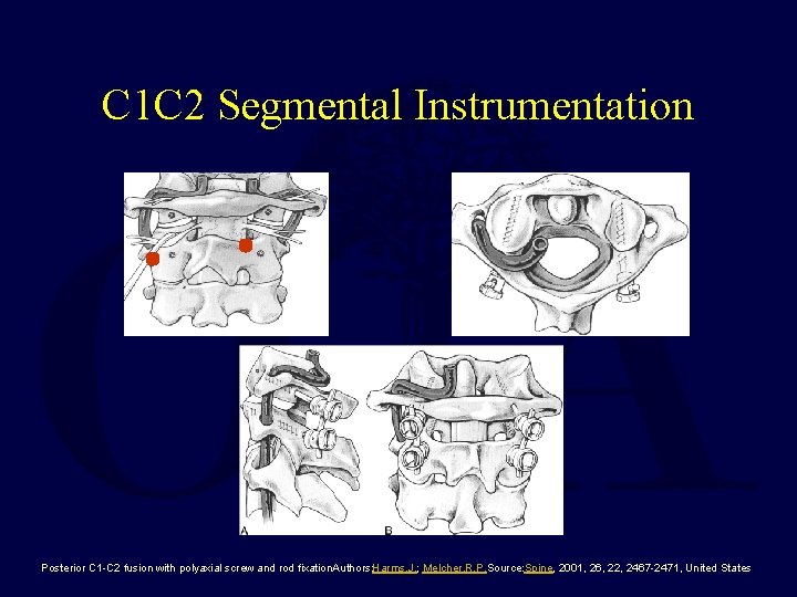 C 1 C 2 Segmental Instrumentation Posterior C 1 -C 2 fusion with polyaxial