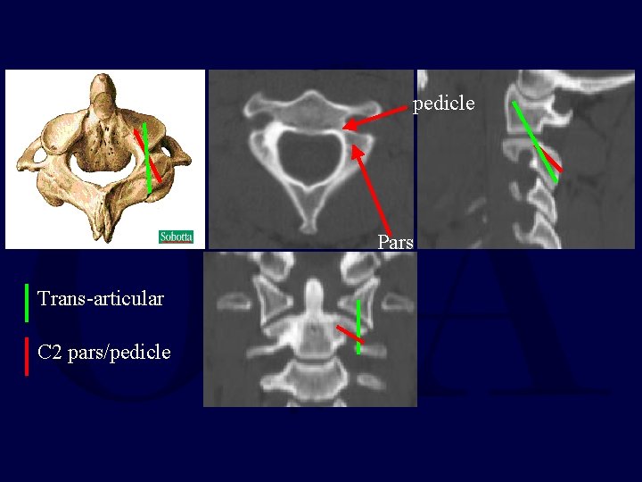 pedicle Pars Trans-articular C 2 pars/pedicle 