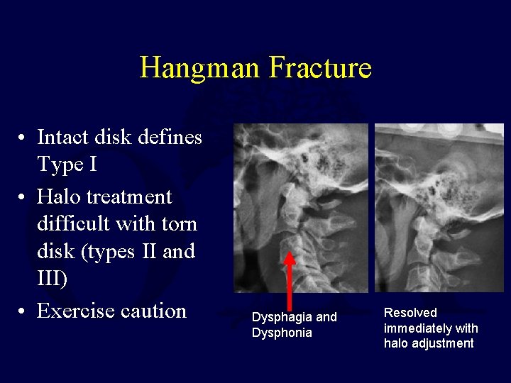 Hangman Fracture • Intact disk defines Type I • Halo treatment difficult with torn