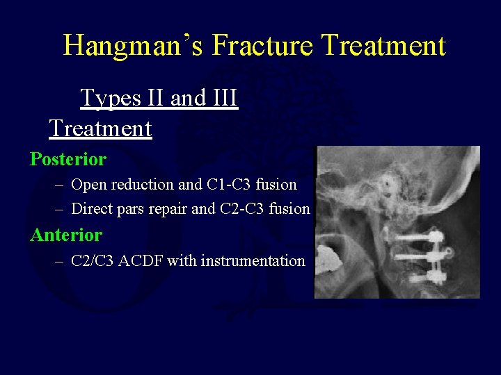 Hangman’s Fracture Treatment Types II and III Treatment Posterior – Open reduction and C