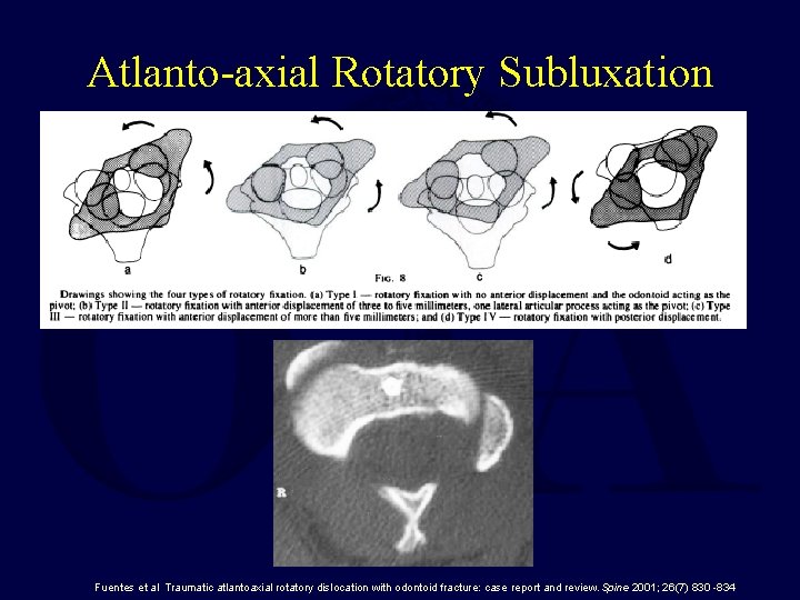 Atlanto-axial Rotatory Subluxation Fuentes et al Traumatic atlantoaxial rotatory dislocation with odontoid fracture: case