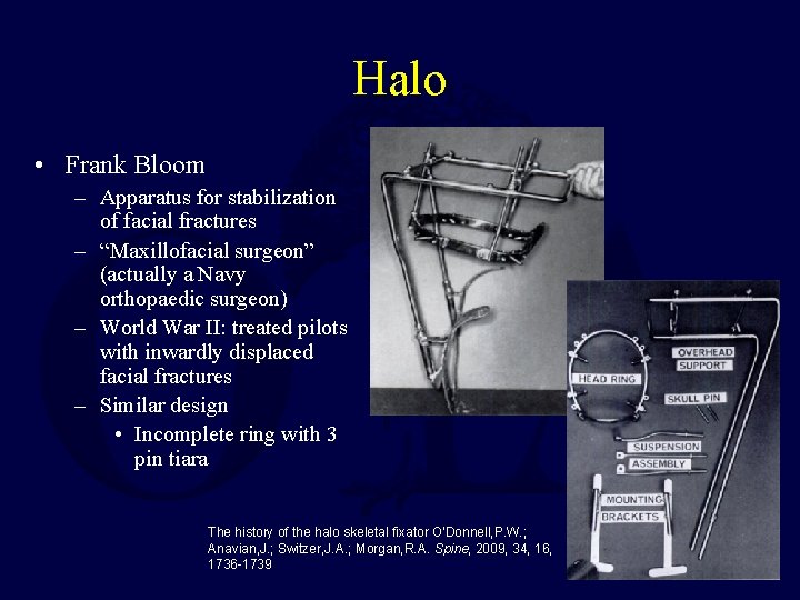 Halo • Frank Bloom – Apparatus for stabilization of facial fractures – “Maxillofacial surgeon”