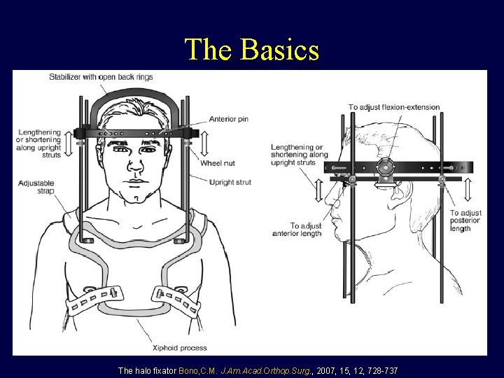 The Basics The halo fixator Bono, C. M. J. Am. Acad. Orthop. Surg. ,