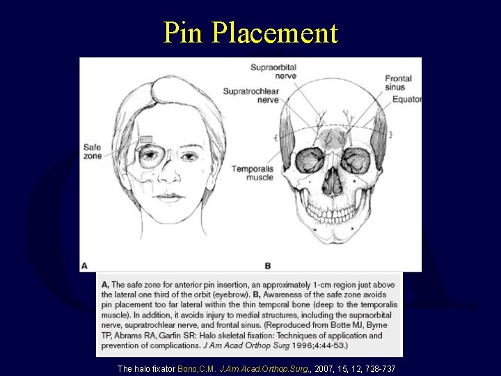 Pin Placement The halo fixator Bono, C. M. J. Am. Acad. Orthop. Surg. ,