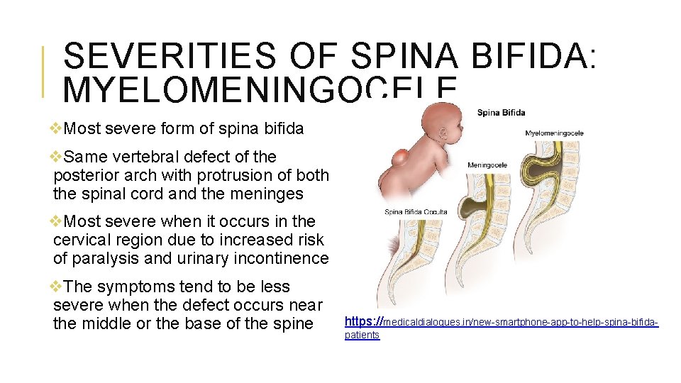 SEVERITIES OF SPINA BIFIDA: MYELOMENINGOCELE v. Most severe form of spina bifida v. Same