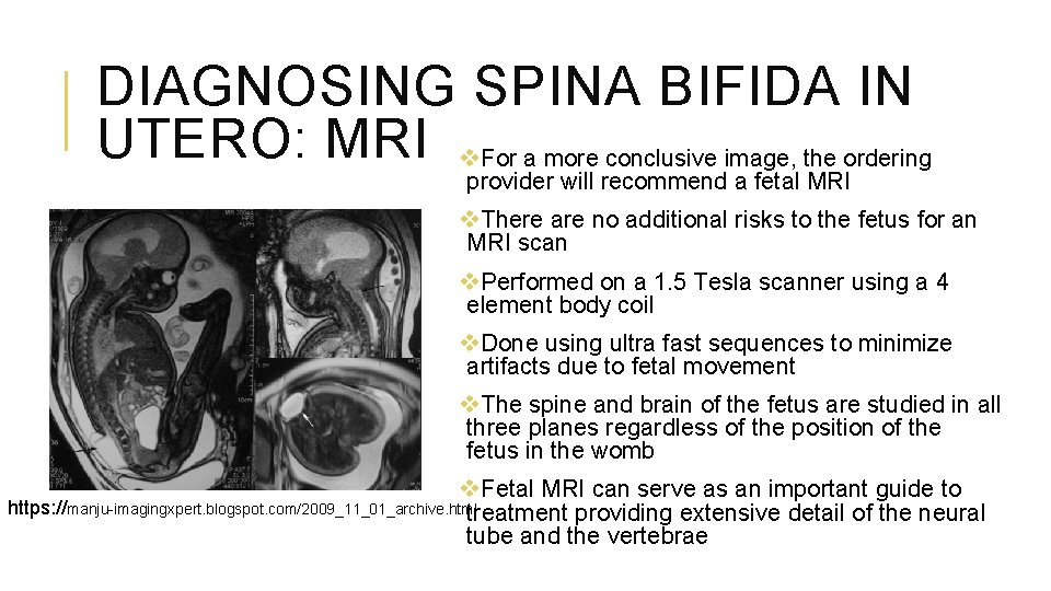 DIAGNOSING SPINA BIFIDA IN UTERO: MRI v. For a more conclusive image, the ordering