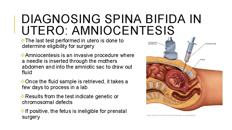 DIAGNOSING SPINA BIFIDA IN UTERO: AMNIOCENTESIS v. The last test performed in utero is