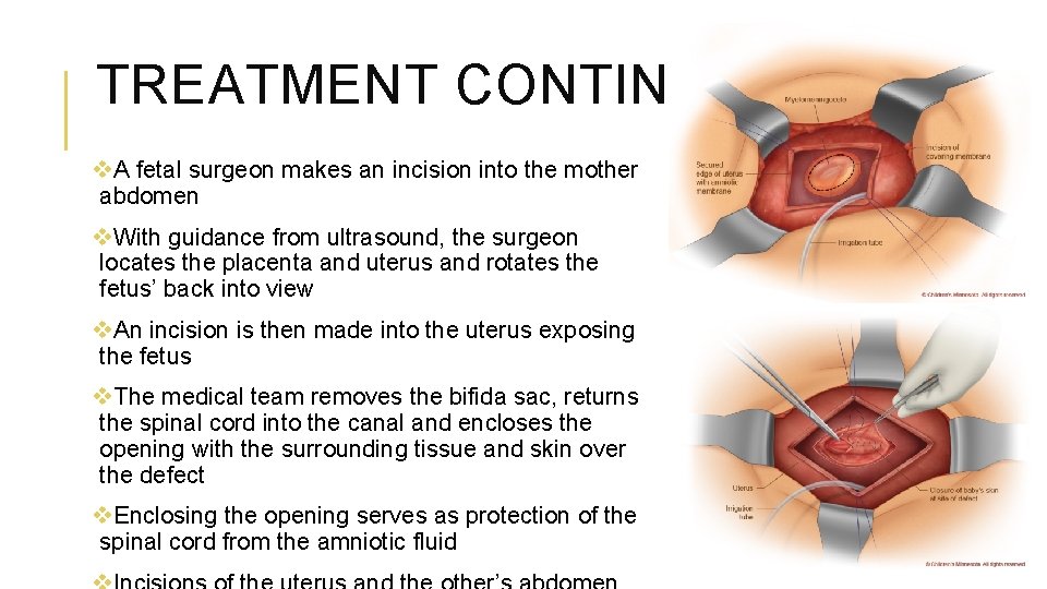 TREATMENT CONTINUED v. A fetal surgeon makes an incision into the mother abdomen v.