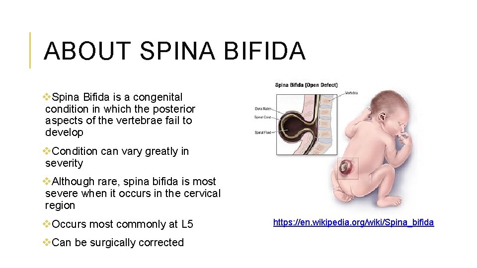 ABOUT SPINA BIFIDA v. Spina Bifida is a congenital condition in which the posterior