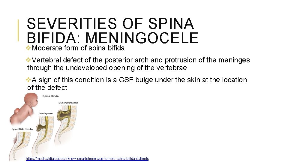 SEVERITIES OF SPINA BIFIDA: MENINGOCELE v. Moderate form of spina bifida v. Vertebral defect