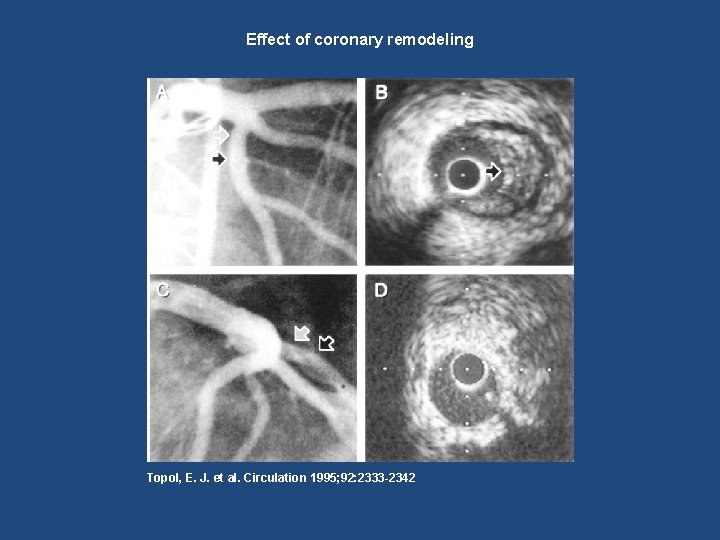 Effect of coronary remodeling Topol, E. J. et al. Circulation 1995; 92: 2333 -2342