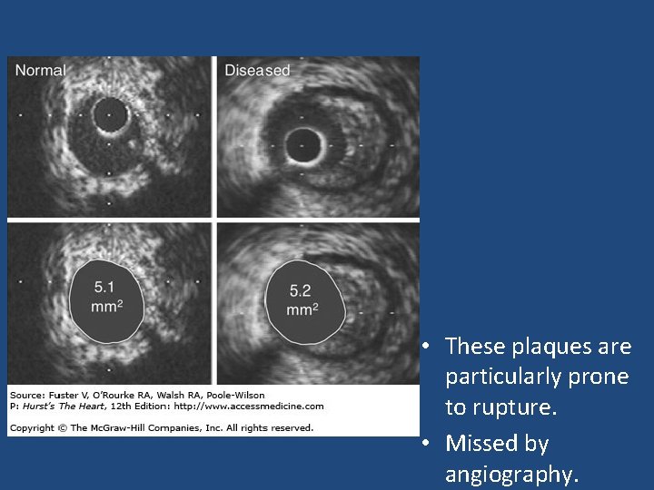  • These plaques are particularly prone to rupture. • Missed by angiography. 