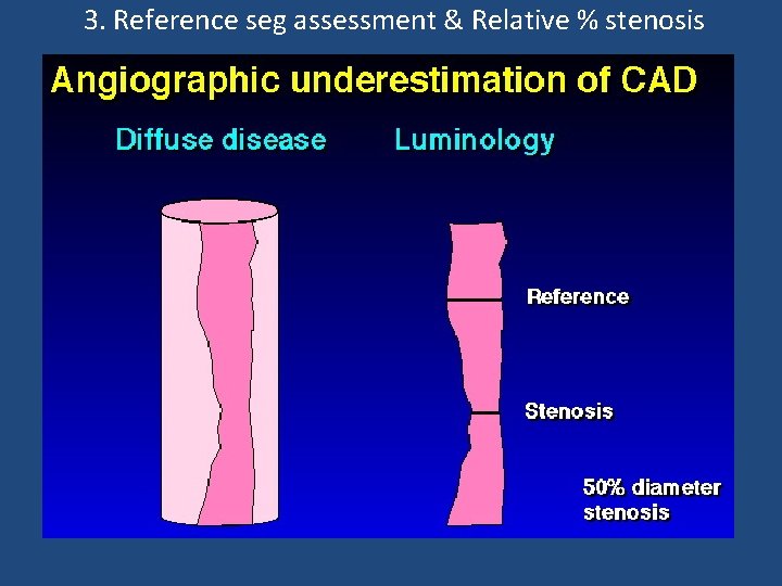 3. Reference seg assessment & Relative % stenosis 