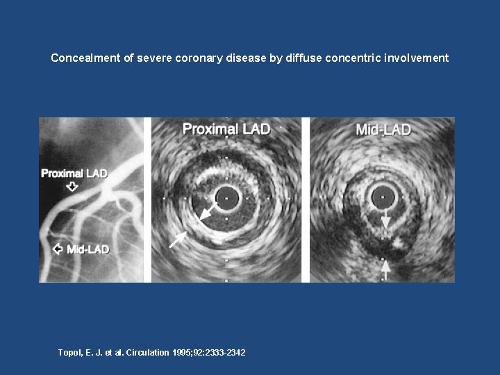 Concealment of severe coronary disease by diffuse concentric involvement Topol, E. J. et al.