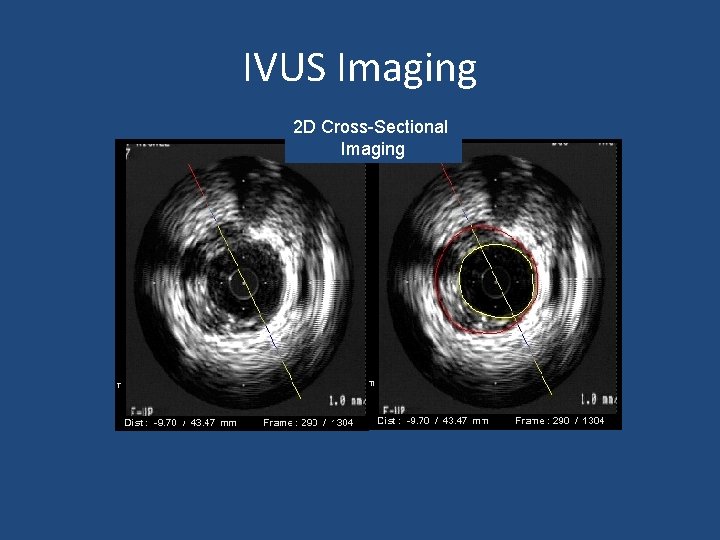 IVUS Imaging 2 D Cross-Sectional Imaging 