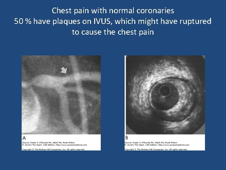 Chest pain with normal coronaries 50 % have plaques on IVUS, which might have