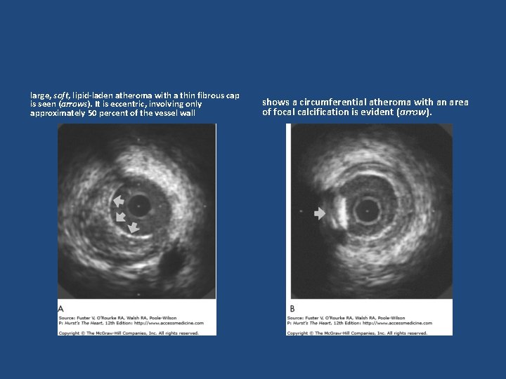 large, soft, lipid-laden atheroma with a thin fibrous cap is seen (arrows). It is