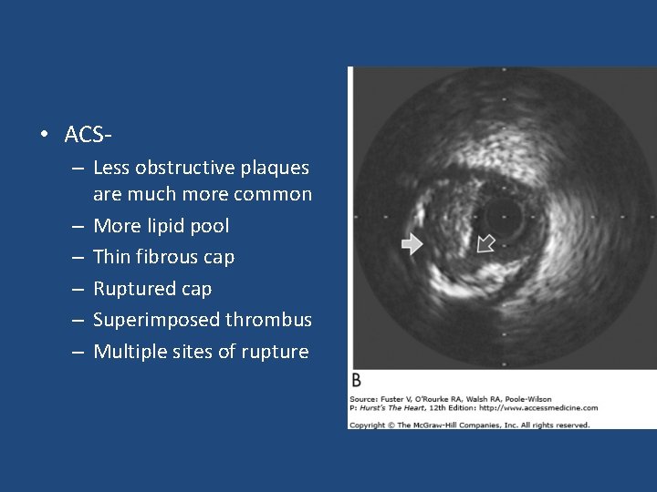  • ACS- – Less obstructive plaques are much more common – More lipid