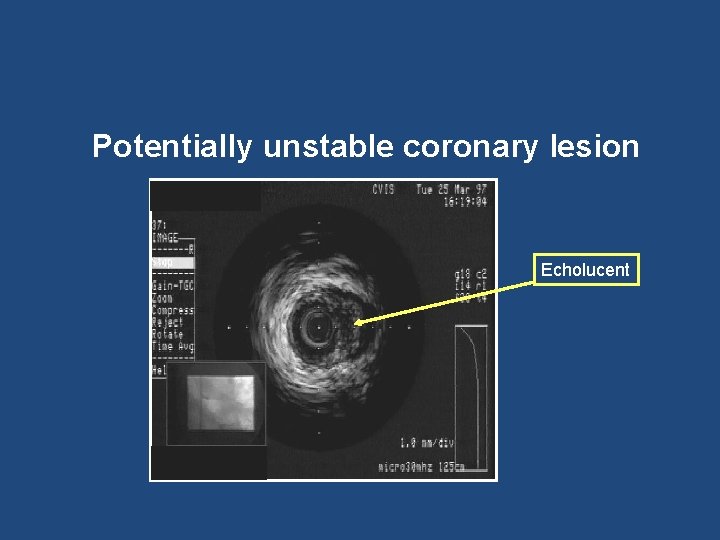 Potentially unstable coronary lesion Echolucent 