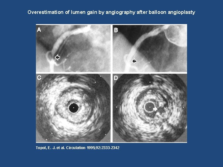 Overestimation of lumen gain by angiography after balloon angioplasty Topol, E. J. et al.