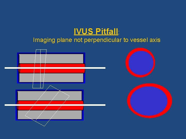 IVUS Pitfall: Imaging plane not perpendicular to vessel axis 