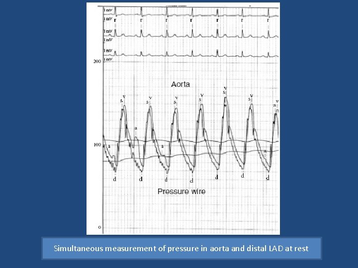  Simultaneous measurement of pressure in aorta and distal LAD at rest 