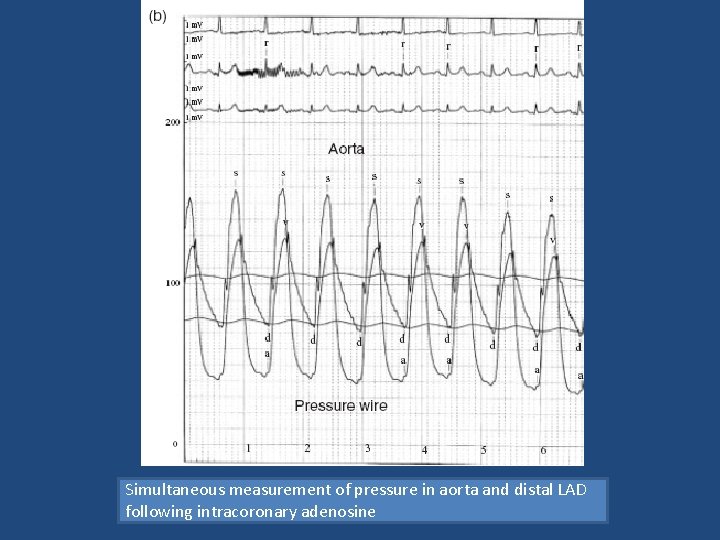 Simultaneous measurement of pressure in aorta and distal LAD following intracoronary adenosine 