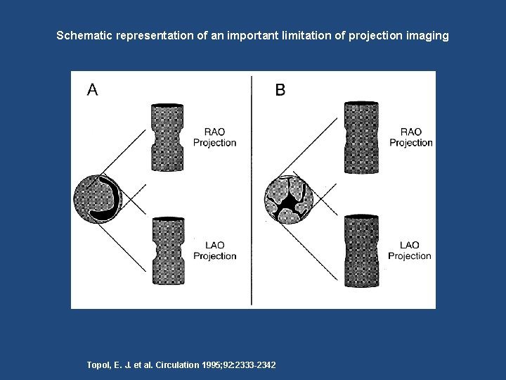 Schematic representation of an important limitation of projection imaging Topol, E. J. et al.