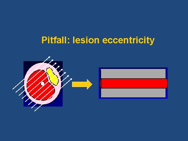 Pitfall: lesion eccentricity 