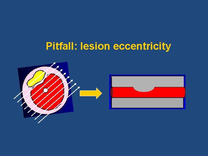 Pitfall: lesion eccentricity 