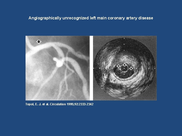 Angiographically unrecognized left main coronary artery disease Topol, E. J. et al. Circulation 1995;