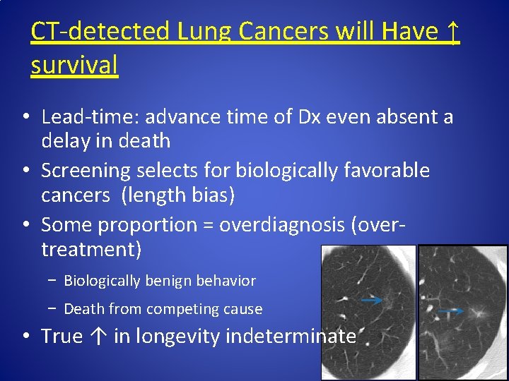 CT-detected Lung Cancers will Have ↑ survival • Lead-time: advance time of Dx even