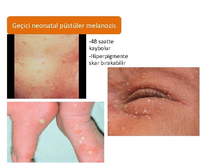 Geçici neonatal püstüler melanozis • -48 saatte kaybolur • -Hiperpigmente skar bırakabilir 
