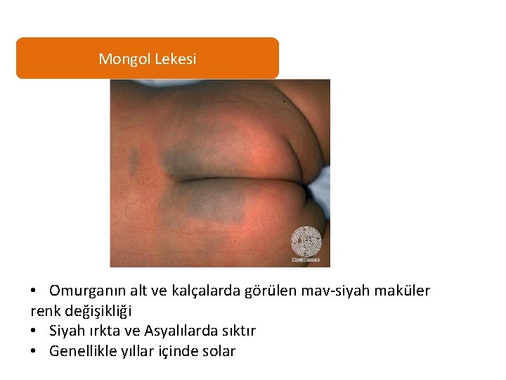 Mongol Lekesi • Omurganın alt ve kalçalarda görülen mav-siyah maküler renk değişikliği • Siyah