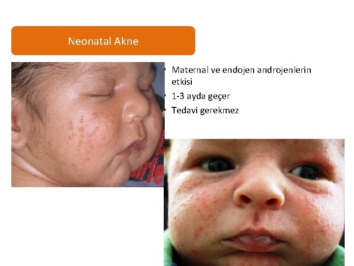 Neonatal Akne • Maternal ve endojen androjenlerin etkisi • 1 -3 ayda geçer •